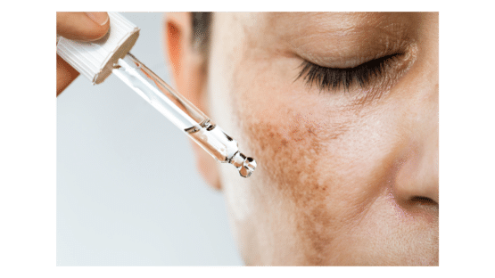 Skin Hyperpigmentation | 3AM