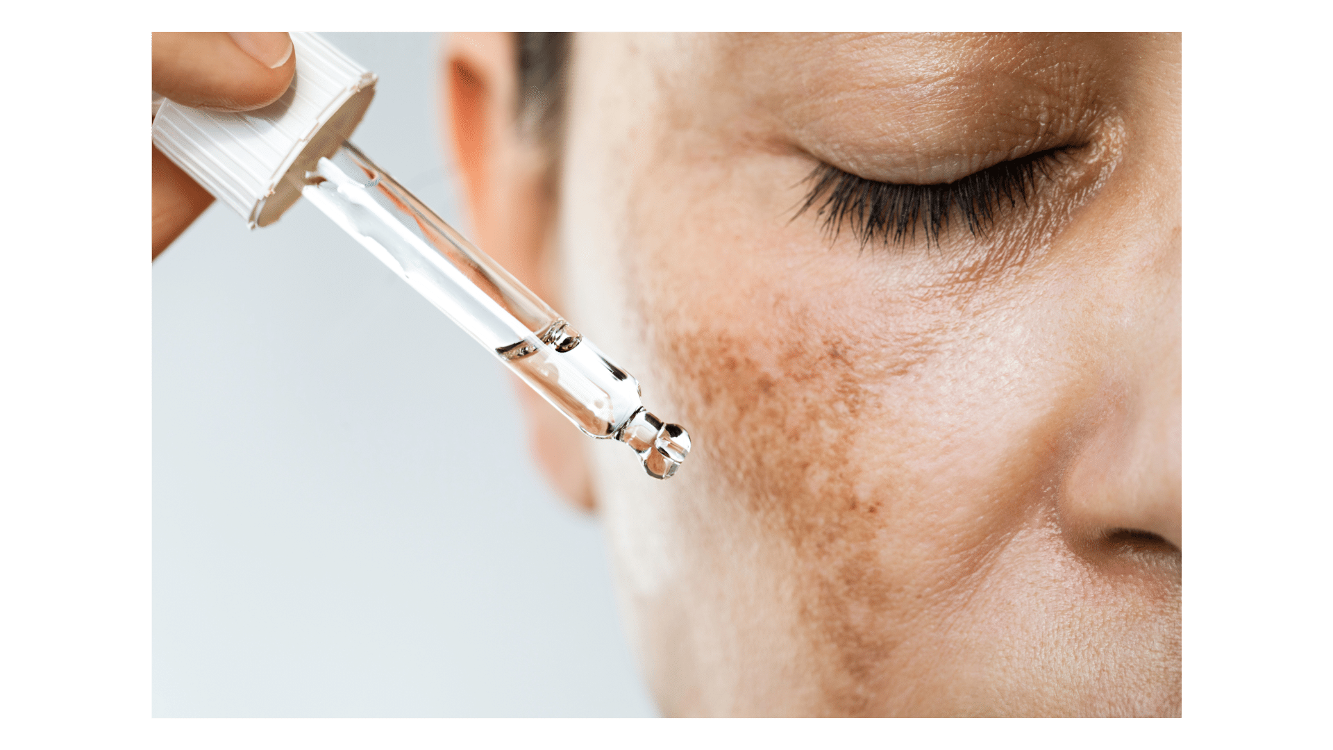 Skin Hyperpigmentation | 3AM